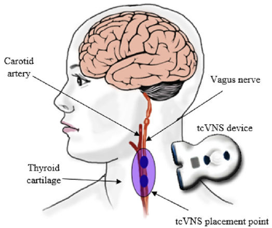 VNS image